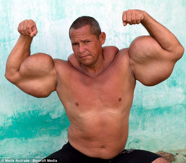 Synthol Opfer Bizeps Sind Synthol Freak Kirill Tereshin Die Arme 